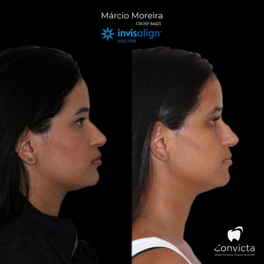 Profile Ortodontia - Antes e depois Invisalign @invisalign é um